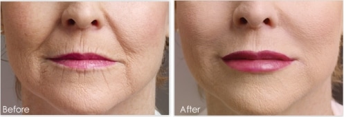 face filler before and after 